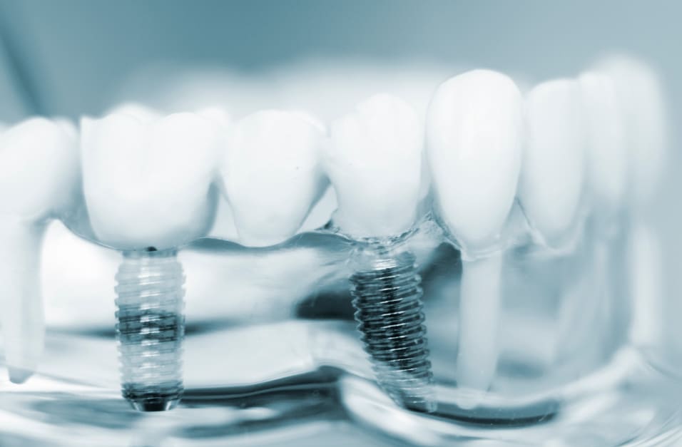 インプラントオペの実践