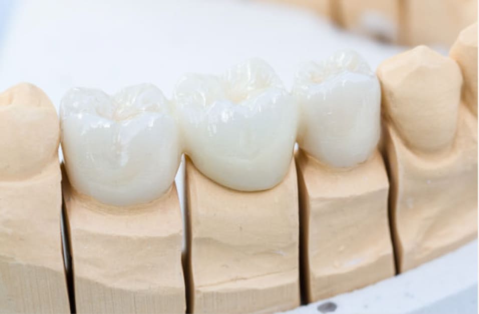 セラミック修復